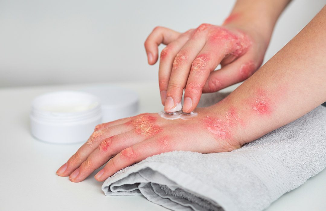 Get valuable information about burns and blisters.