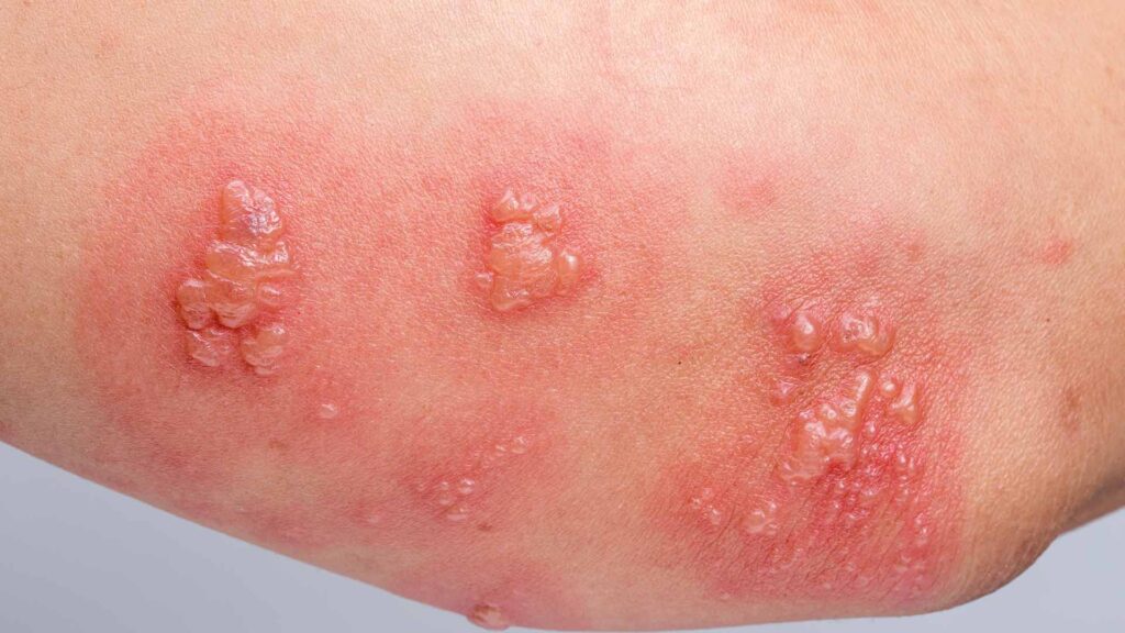 Hundreds of people suffering from this condition wonder how to cure shingles.