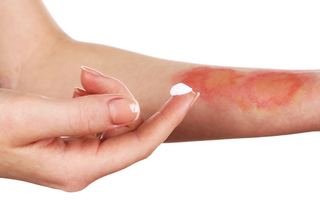 Learn how to treat a burn blister with Novamed.