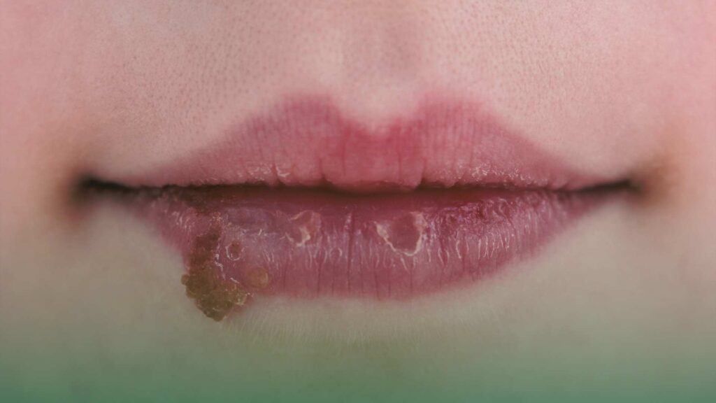 Get fast treatment with Novamed, offering urgent care for herpes. 