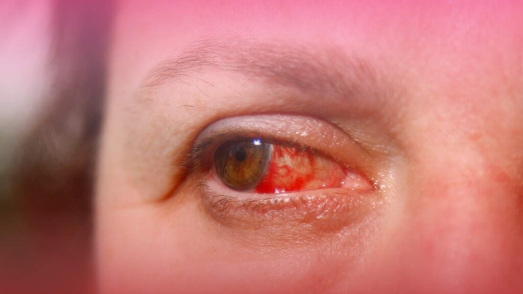 Looking for urgent care for pink eye? Contact Novamed.