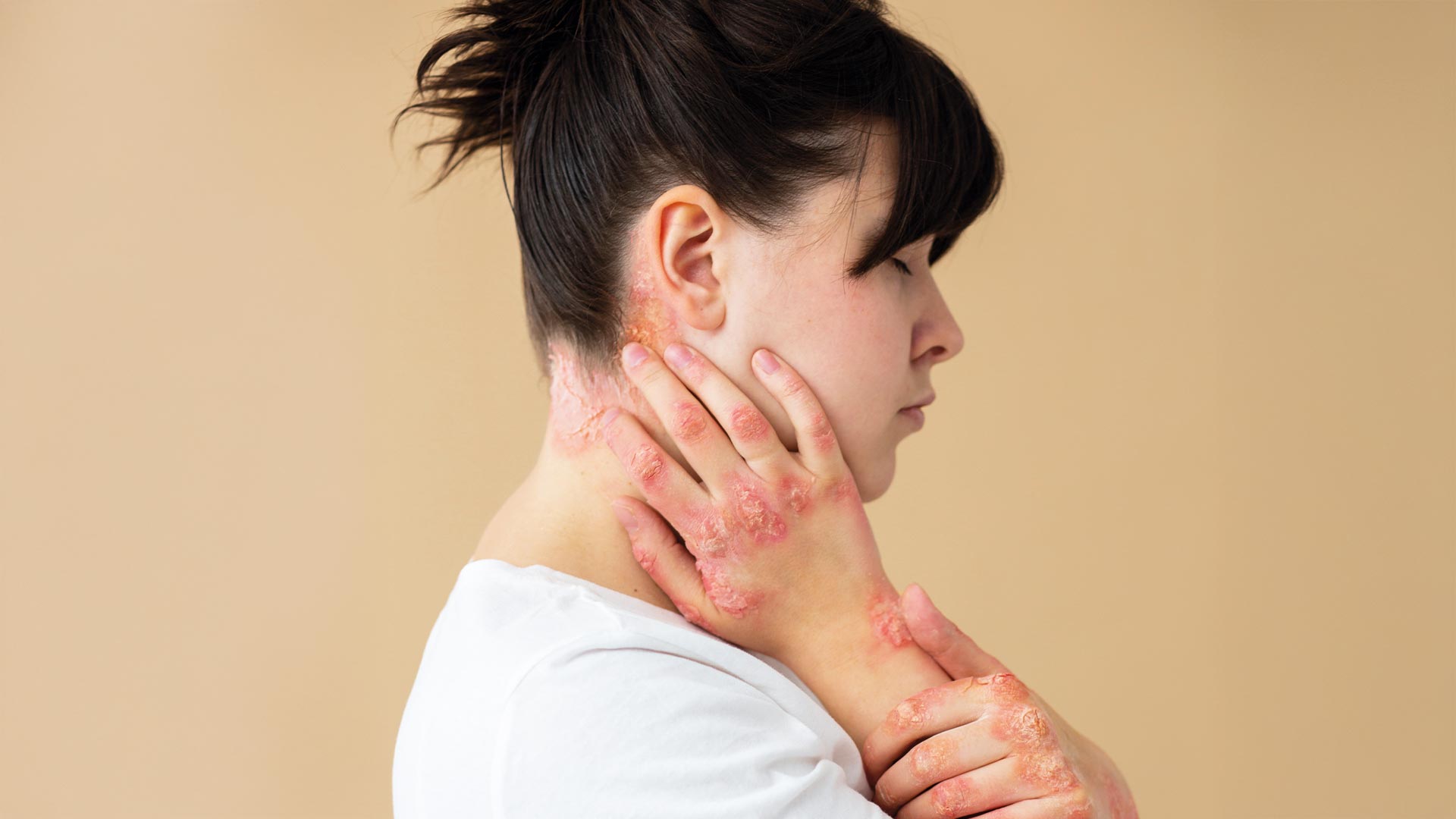 If you need an urgent care for shingles, discover Novamed.