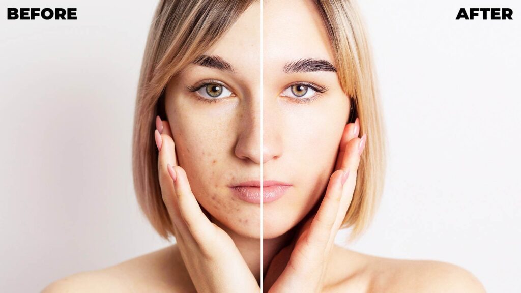 Acne treatment in Illinois urgent care demonstrates remarkable skin transformation from blemished to flawless.