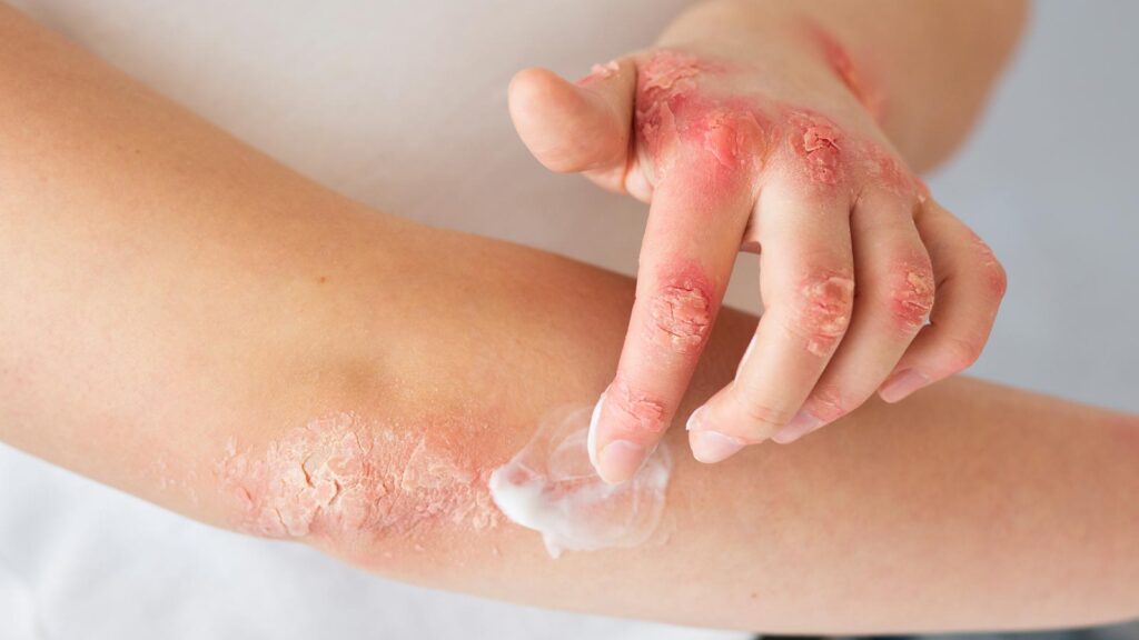 A person applies cream to a skin rash, a common treatment for symptoms managed at rashes treatment in chicago urgent care, emphasizing self-care in skin conditions.