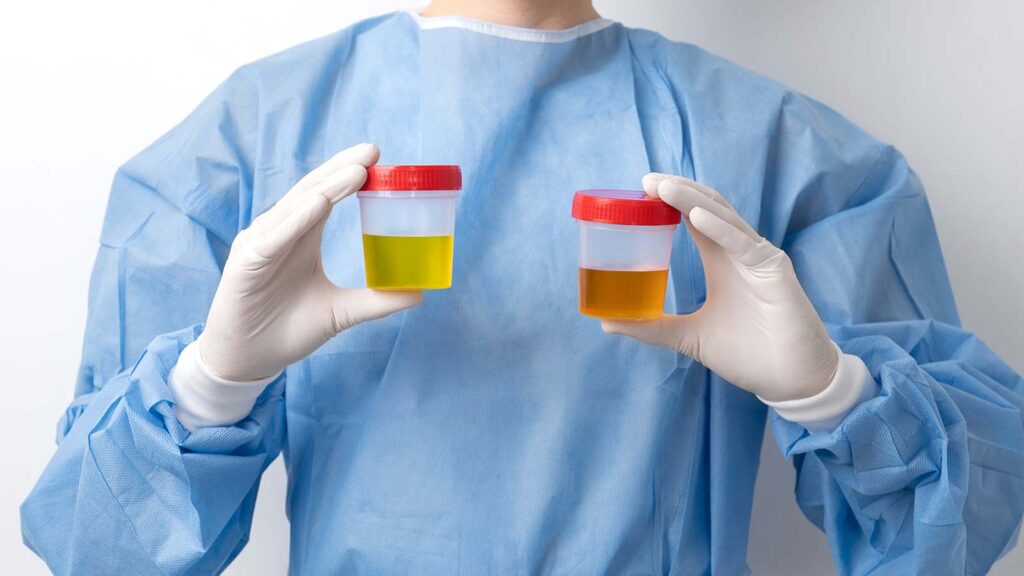 The image shows a medical professional in a blue gown holding two urine samples, symbolizing the urinary tract bladder lab services provided in Chicago urgent care clinic.