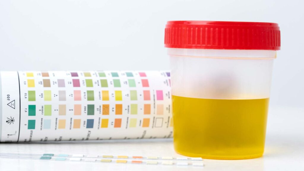 A urine sample container sits in front of a urinalysis color chart, a common tool in urinary tract bladder lab services in Illinois urgent care facilities.