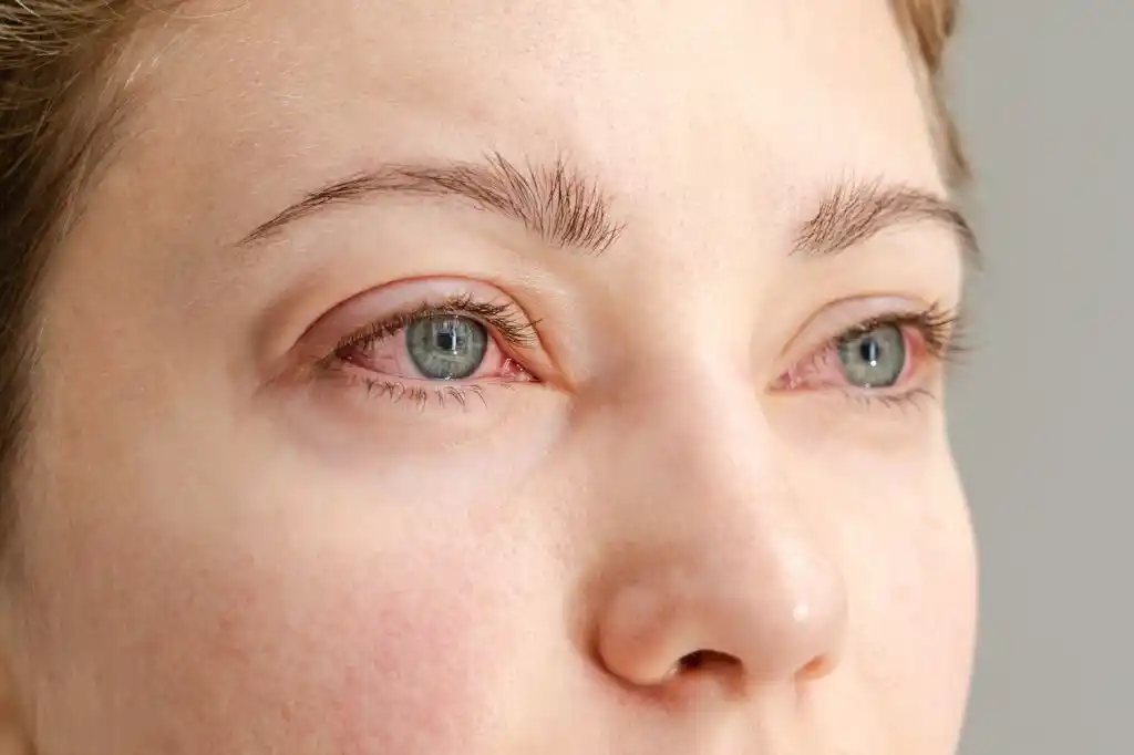 Pink eye or allergies side-by-side comparison