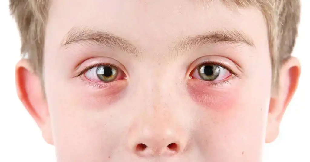 wollen, itchy eye caused by allergic conjunctivitis