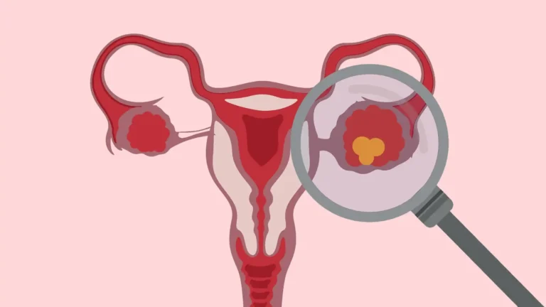 Can A Ovary Cyst Cause Infertility