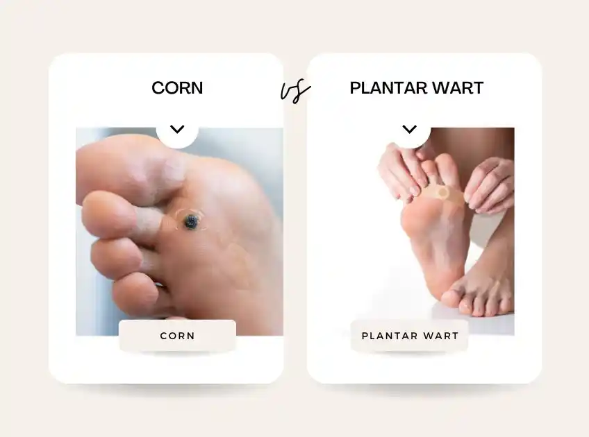 Plantar Wart Vs Corn