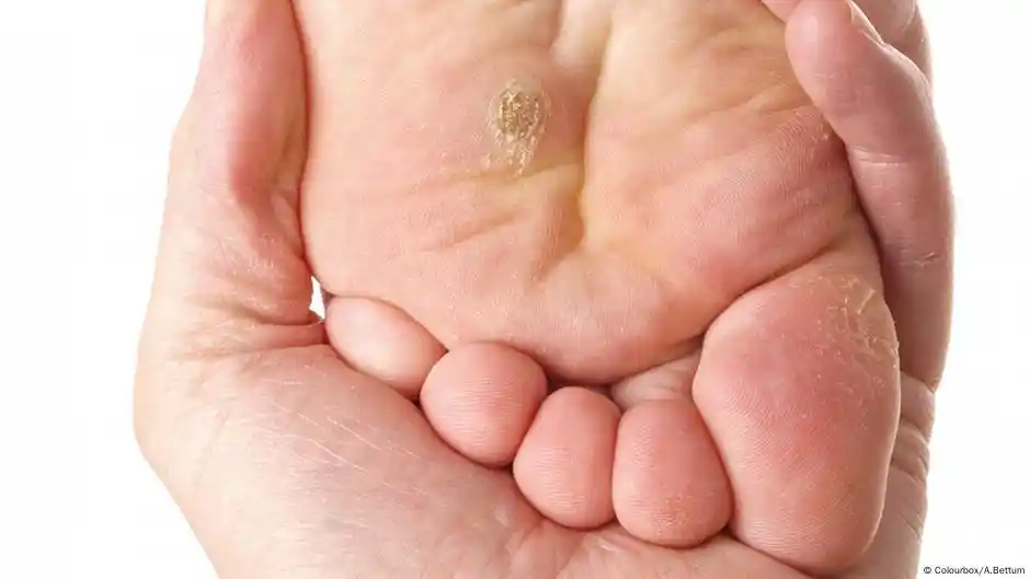 corn vs plantar wart