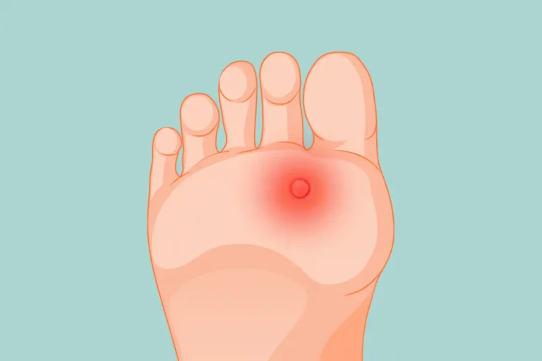 plantar callus vs plantar wart