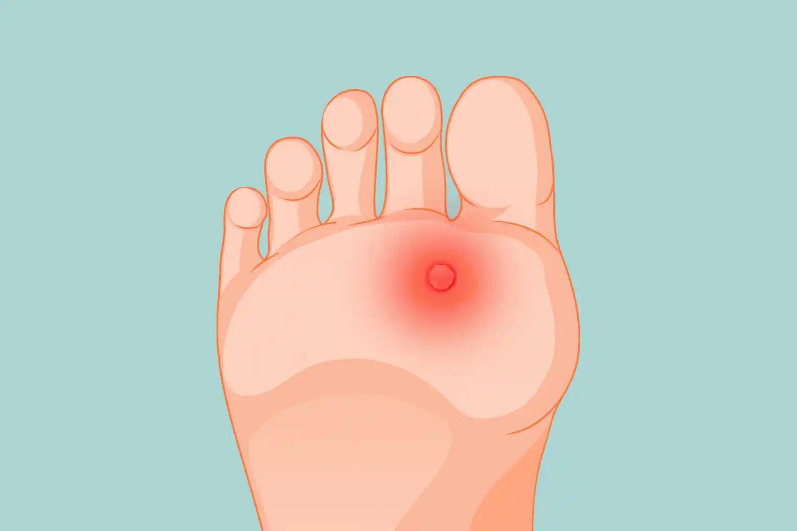plantar callus vs plantar wart